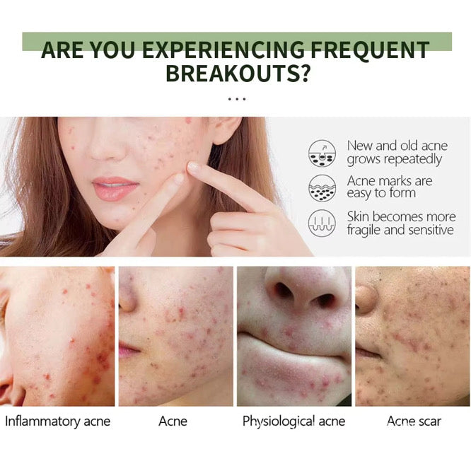 Salicylic Acid Acne Cream - Max Strength Formula