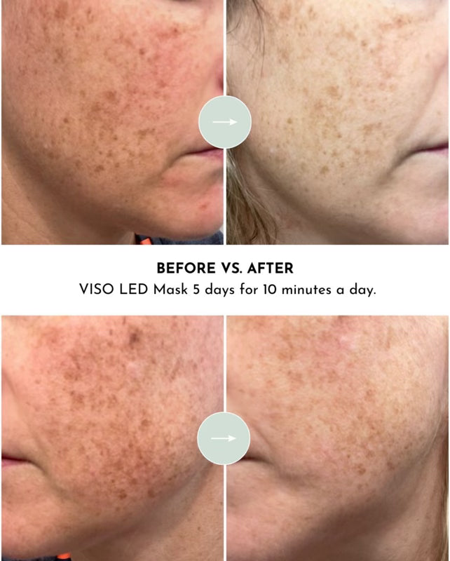 VISO - FDA Certified Red Light Therapy Mask by Lumara